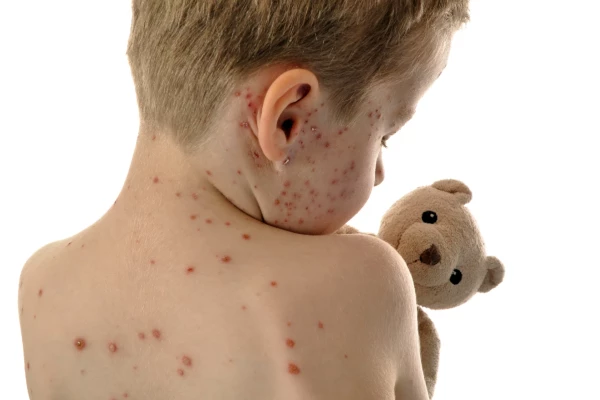 Image for article titled Guidance relating to the measles outbreak